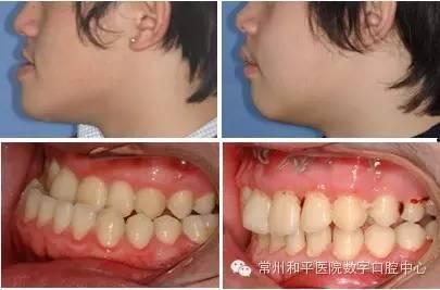 成人地包天要正畸视频,跟随正畸视频见证蜕变过程