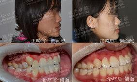 成人地包天要正畸视频,跟随正畸视频见证蜕变过程